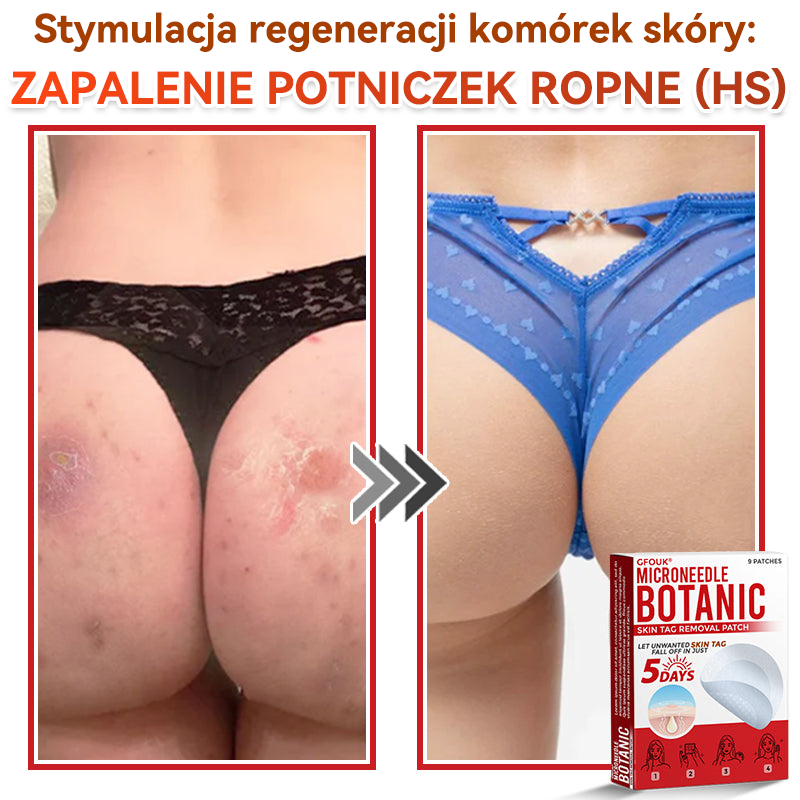 ✅ GFOUK® Plastry do usuwania brodawek i znamion z mikronakłuciami roślinnymi