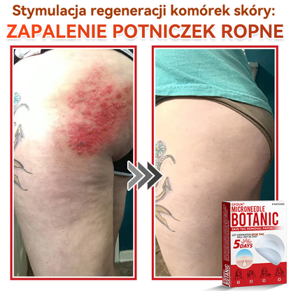 ✅ GFOUK® Plastry do usuwania brodawek i znamion z mikronakłuciami roślinnymi