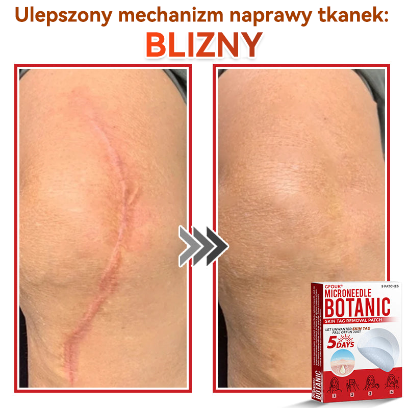 ✅ GFOUK® Plastry do usuwania brodawek i znamion z mikronakłuciami roślinnymi