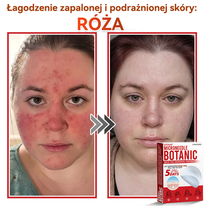 ✅ GFOUK® Plastry do usuwania brodawek i znamion z mikronakłuciami roślinnymi