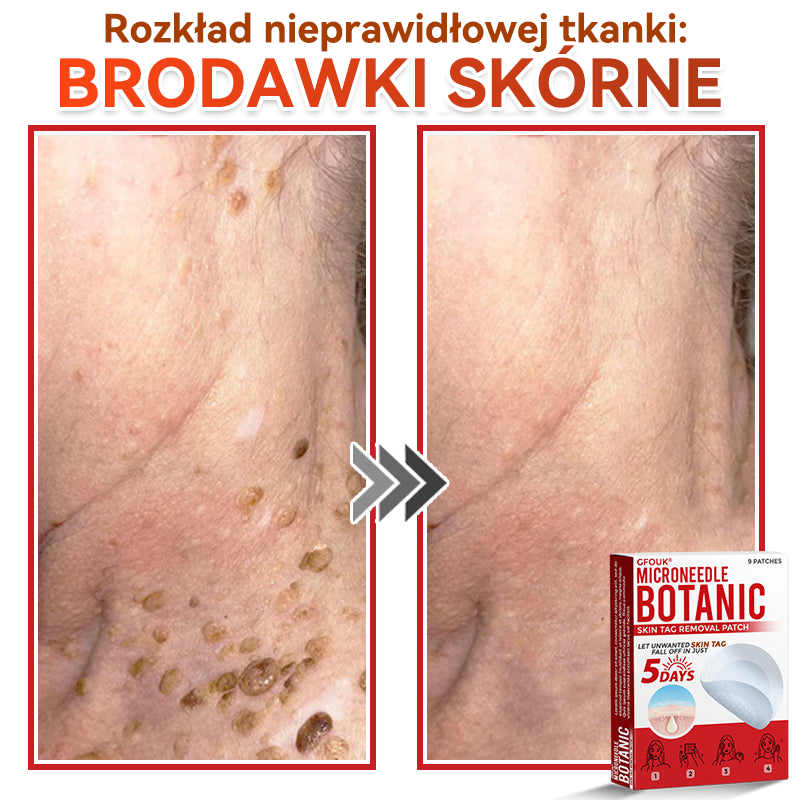 ✅ GFOUK® Plastry do usuwania brodawek i znamion z mikronakłuciami roślinnymi