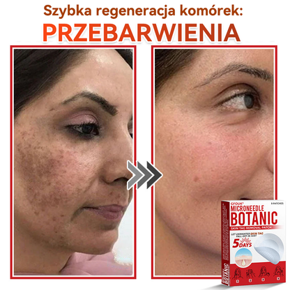 ✅ GFOUK® Plastry do usuwania brodawek i znamion z mikronakłuciami roślinnymi