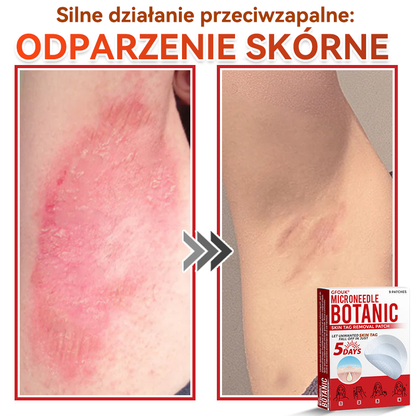 ✅ GFOUK® Plastry do usuwania brodawek i znamion z mikronakłuciami roślinnymi